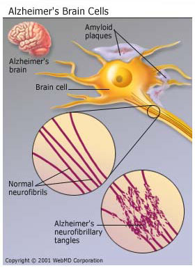 neurofibrillary tangles